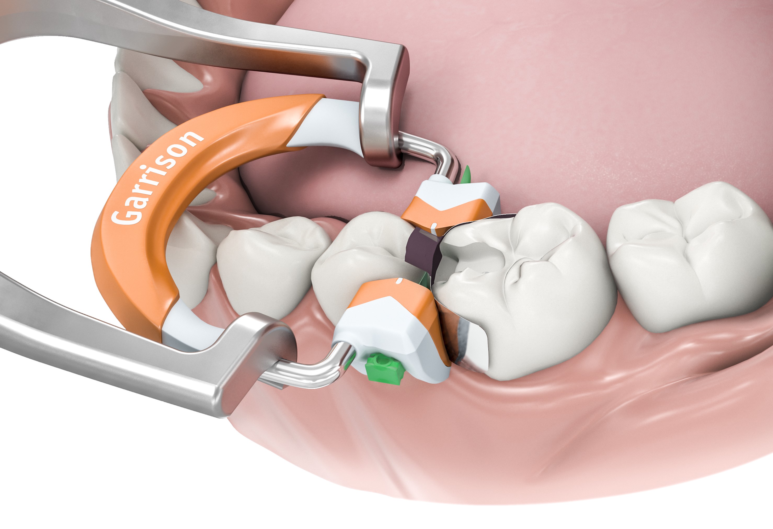 Composi Tight D Fusion Matrix Rings